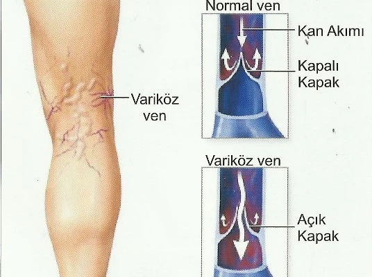 Varislerde Erken Teşhis ve Tedavi Önemli