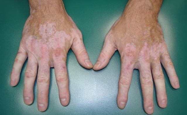 vitiligo_